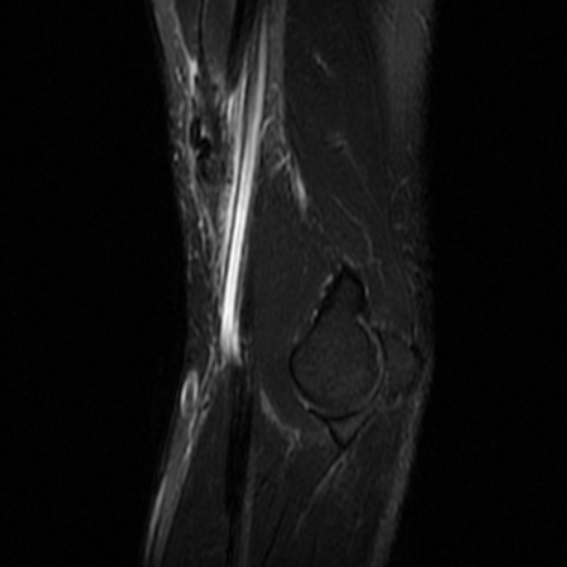 Distal biceps brachii tendon tear with retraction | Image | Radiopaedia.org