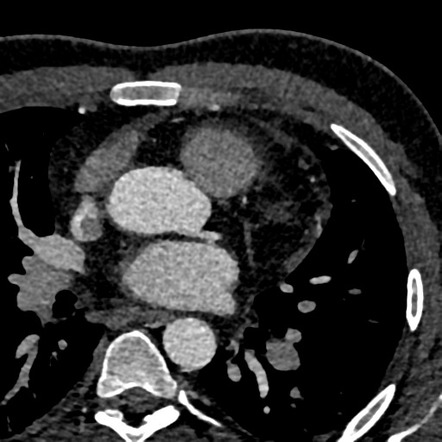 LCx and LAD arising separately from the left coronary sinus | Radiology ...