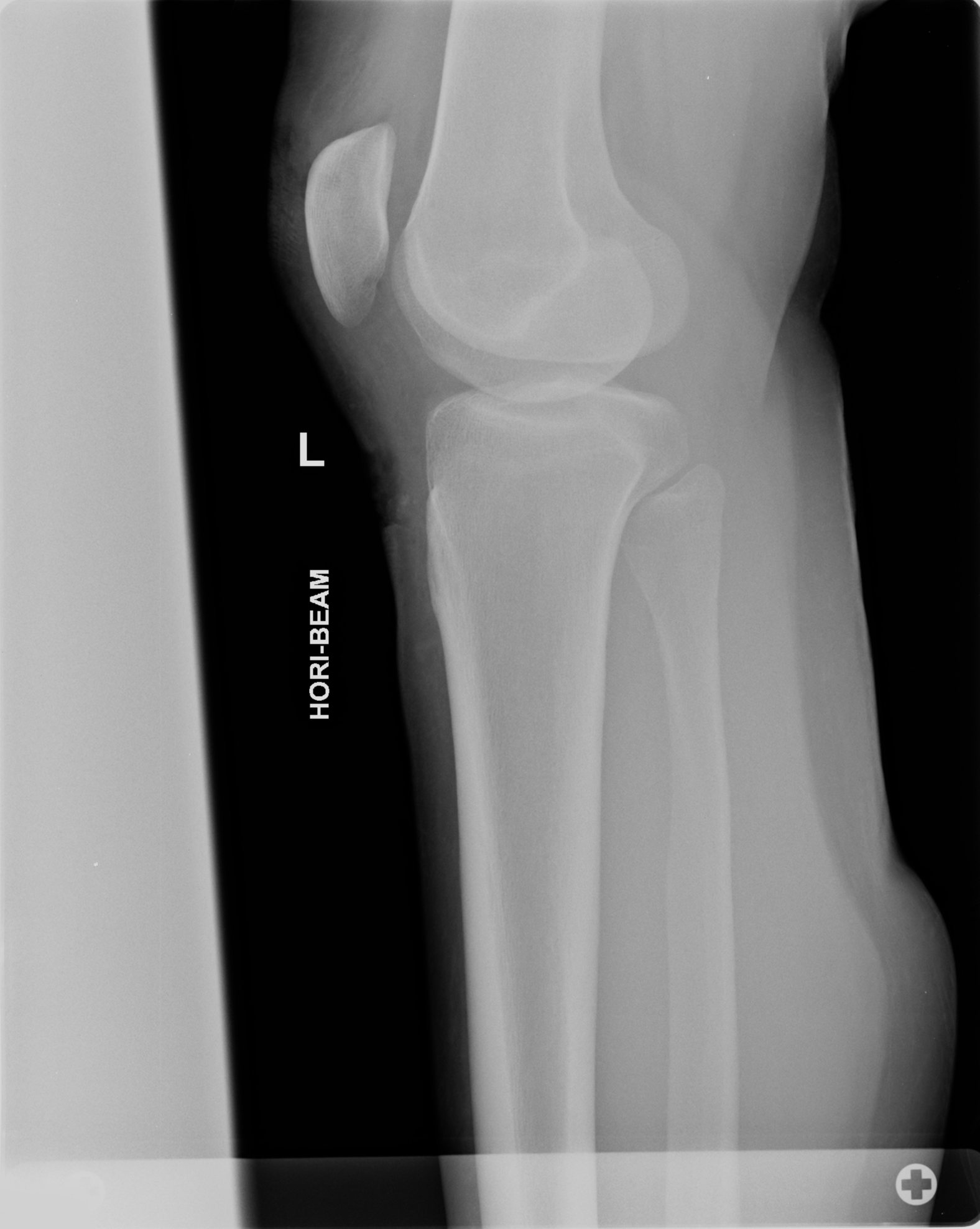 Tibia Fibula X Ray