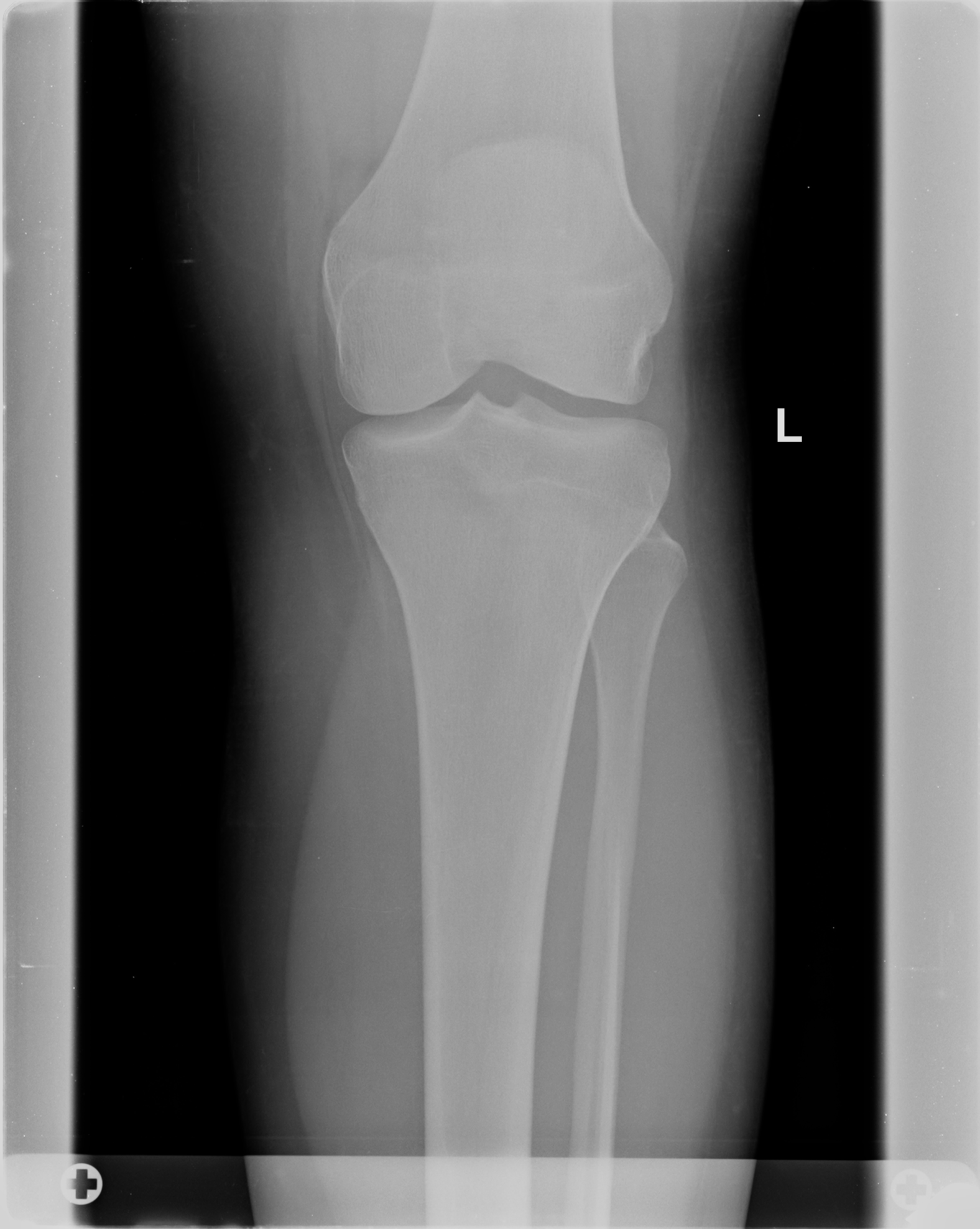 Normal Tibia Fibula Series Image Radiopaedia Org