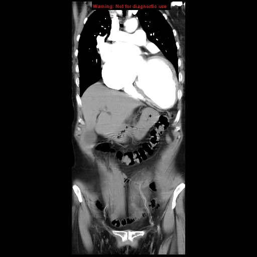 left-atrial-enlargement-image-radiopaedia