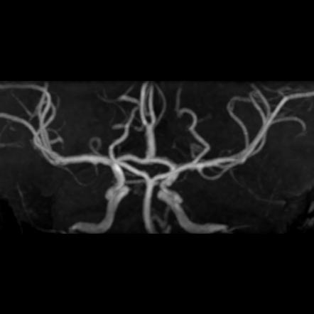 Azygos anterior cerebral artery | Radiology Case | Radiopaedia.org