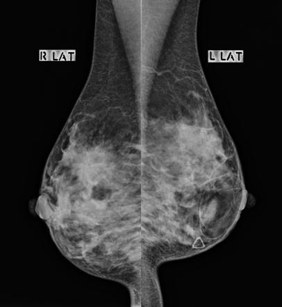 Breast Hamartoma Radiology Reference Article Radiopaedia Org