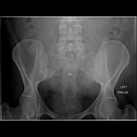 Normal voiding cystourethrogram | Radiology Case | Radiopaedia.org