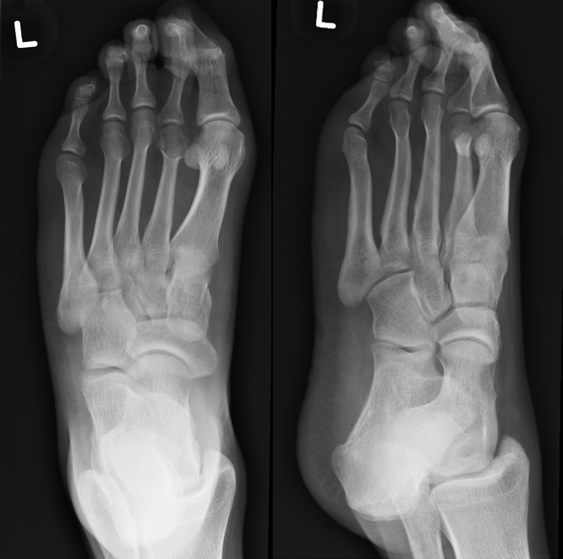 Short Second Metatarsal 