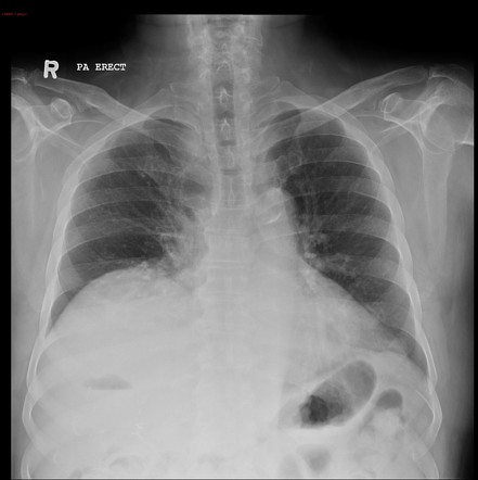 Gallbladder fossa abscess | Image | Radiopaedia.org