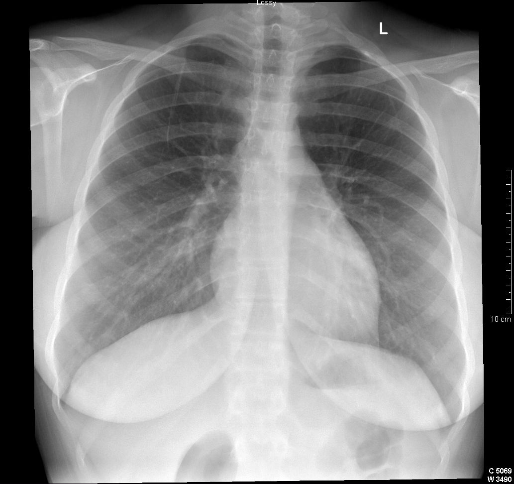 Cervical rib | Image | Radiopaedia.org