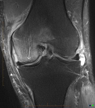 Transient bone marrow edema (knee) | Image | Radiopaedia.org