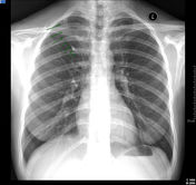 Azygos lobe | Radiology Reference Article | Radiopaedia.org thoracic duct diagram 