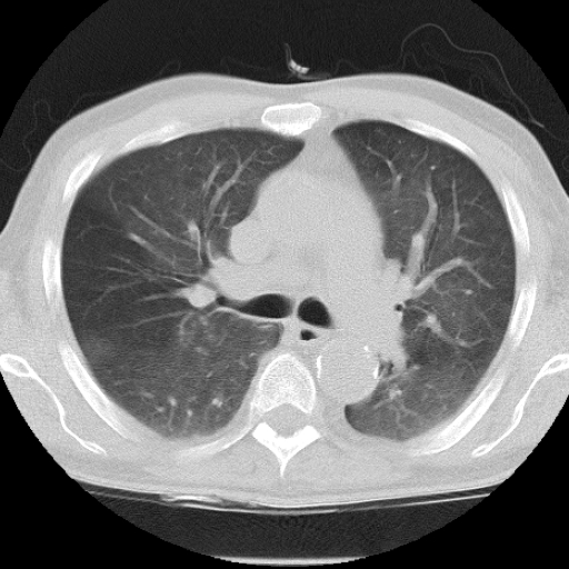 Interstitial pulmonary edema | Image | Radiopaedia.org