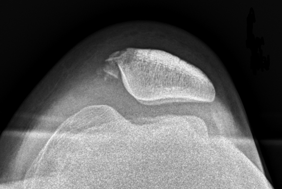 Patellar Avulsion Fracture