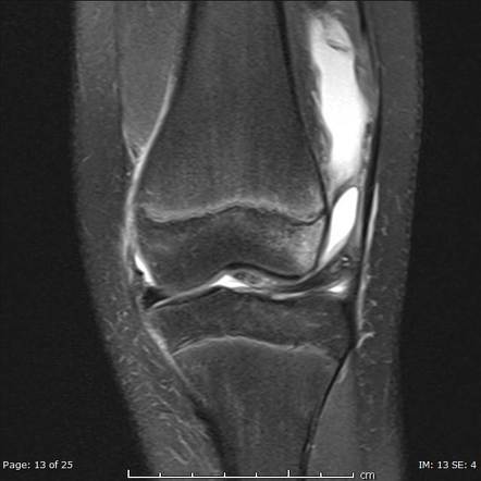 Avulsion fracture of the medial patellofemoral ligament | Image ...