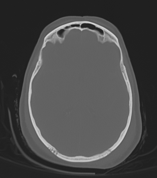 Diffuse Cerebral Edema 