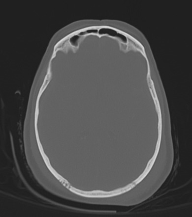 Diffuse cerebral edema | Image | Radiopaedia.org