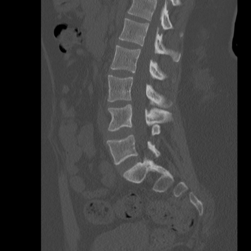 Fused hemivertebra | Image | Radiopaedia.org