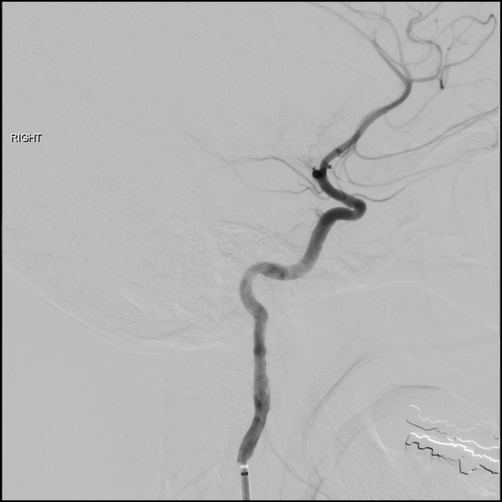 Right MCA infarct | Image | Radiopaedia.org