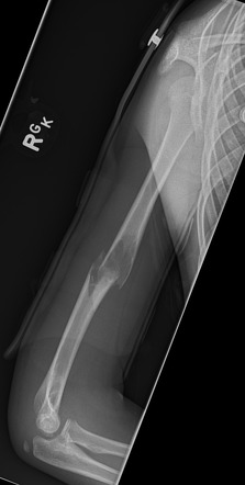 Pathological fracture secondary to fibrous dysplasia | Image ...