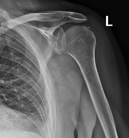 Bankart lesion | Radiology Case | Radiopaedia.org