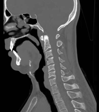 Vertebral pneumatocyst | Radiology Reference Article | Radiopaedia.org