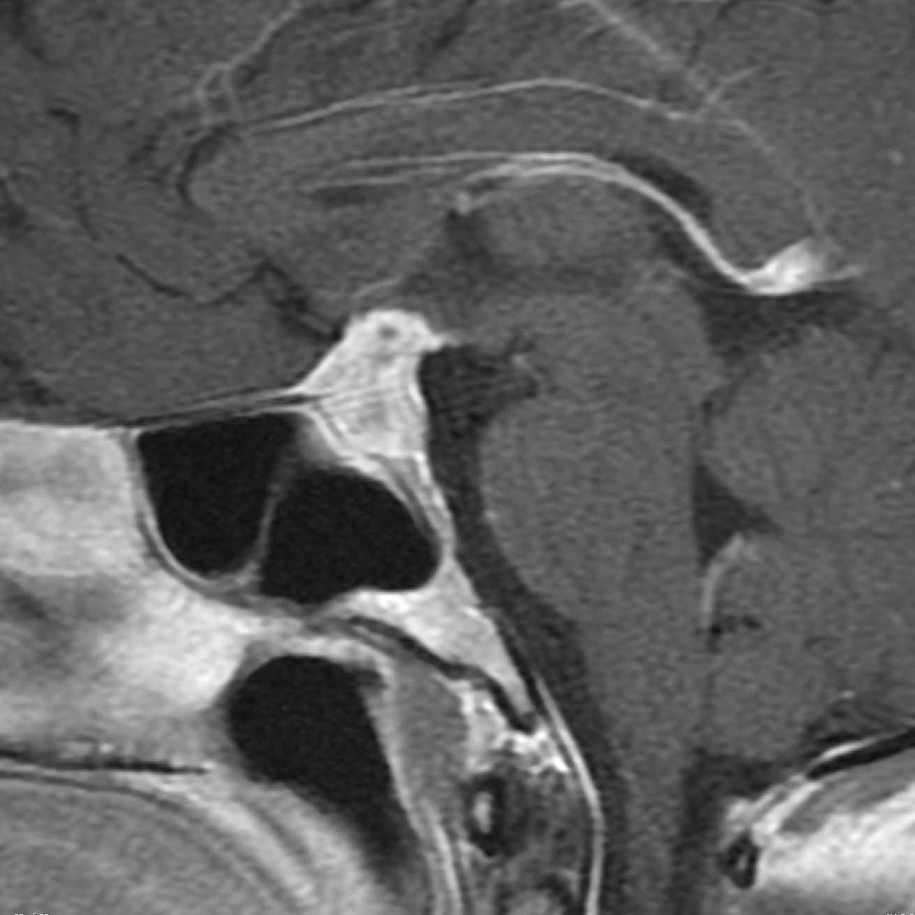 Lymphocytic Hypophysitis Image