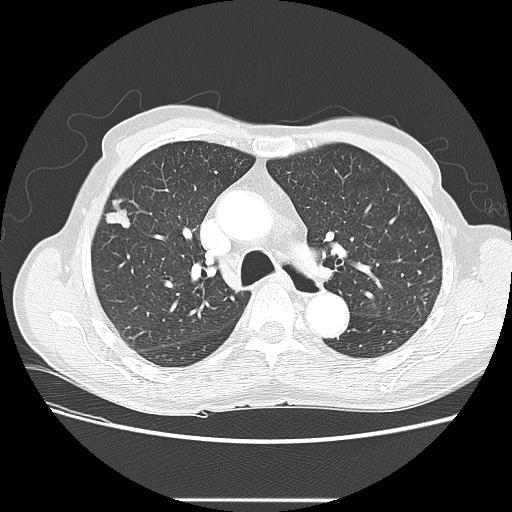 Bronchocele | Radiology Case | Radiopaedia.org