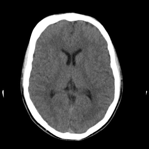 Fibrous dysplasia of the orbital roof | Image | Radiopaedia.org