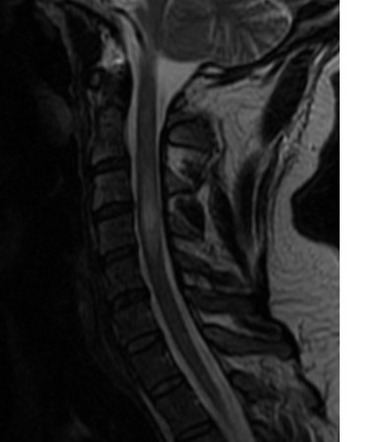 Multiple Sclerosis Of The Spine Radiology Case Radiopaedia Org