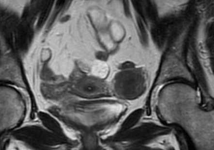 Solid ovarian tumor - histology unknown | Radiology Case | Radiopaedia.org