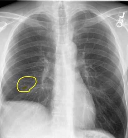 Pulmonary embolism | Radiology Reference Article | Radiopaedia.org