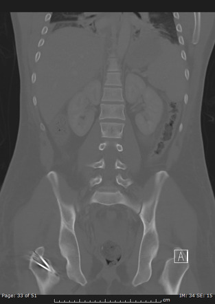 Ganz trochanteric flip surgery | Image | Radiopaedia.org