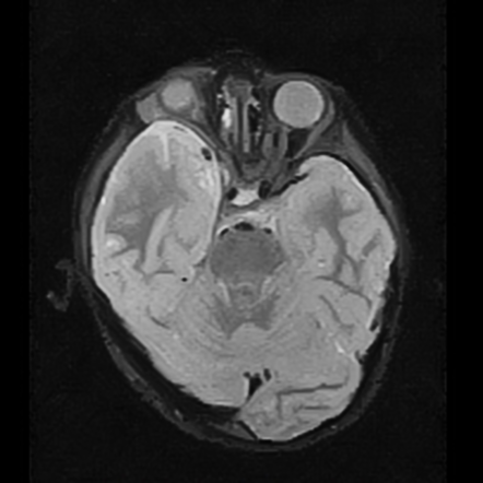 Sphenoid wing dysplasia (bare orbit) | Image | Radiopaedia.org