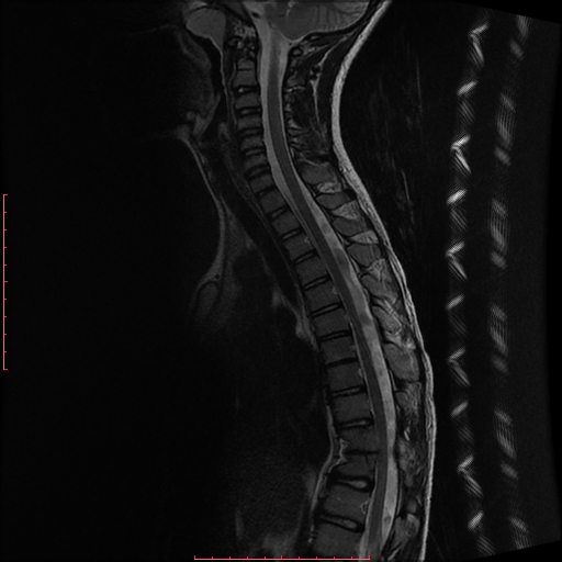 Hemivertebra with congenital scoliosis | Image | Radiopaedia.org