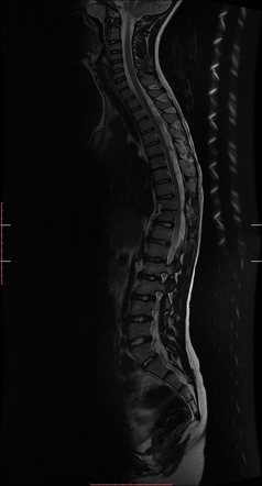 Hemivertebra with congenital scoliosis | Image | Radiopaedia.org