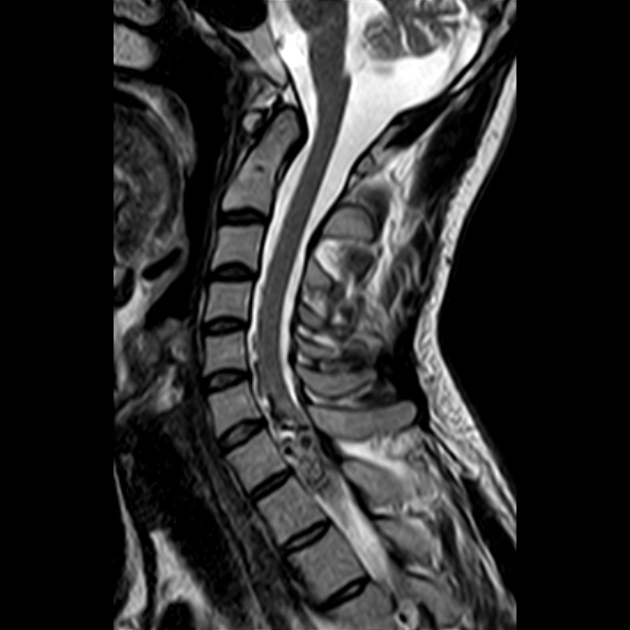 Spinal arteriovenous malformation | Image | Radiopaedia.org