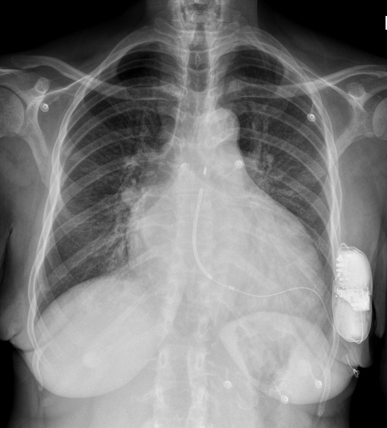 Subcutaneous implantable defibrillator | Image | Radiopaedia.org