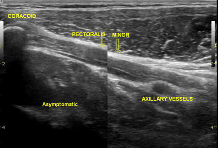 Poland syndrome | Radiology Case | Radiopaedia.org