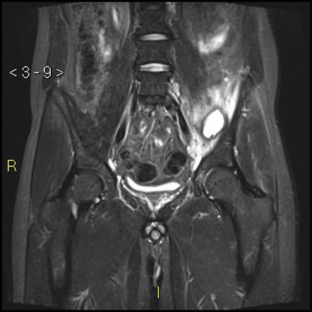 Abscess and empyema of the iliacus muscle and the sacroiliac joint ...