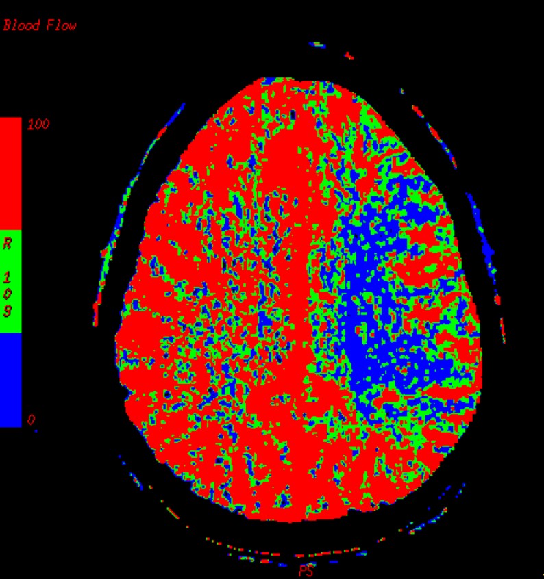 Carotid dissection with watershed infarct | Image | Radiopaedia.org