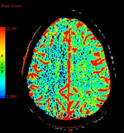 Carotid dissection with watershed infarct | Image | Radiopaedia.org