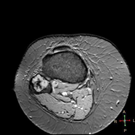 Enchondroma - fibula | Radiology Case | Radiopaedia.org