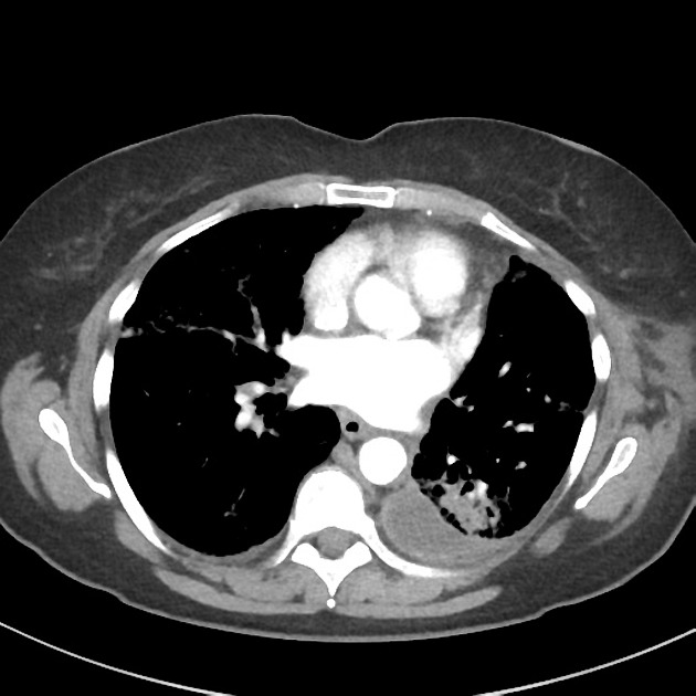 Featured image of post Radiopaedia Organising Pneumonia In industrialized nations it is the leading infectious cause o