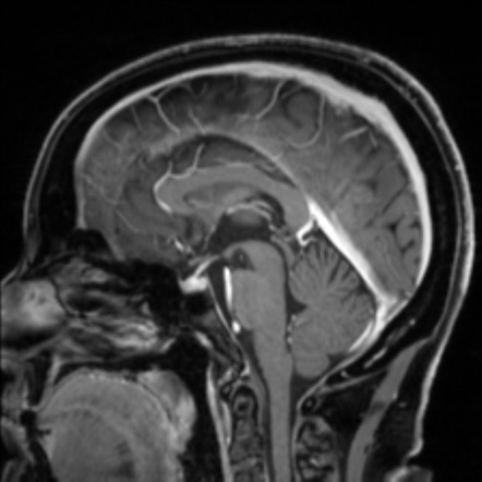 Normal MRI internal auditory canal | Image | Radiopaedia.org