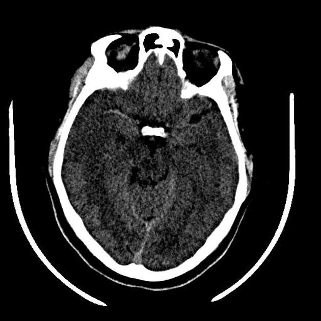 Characterization of the 'White' Appearing Clots that Cause Acute