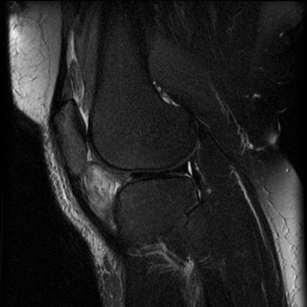 Fibroma of the tendon sheath - knee | Image | Radiopaedia.org