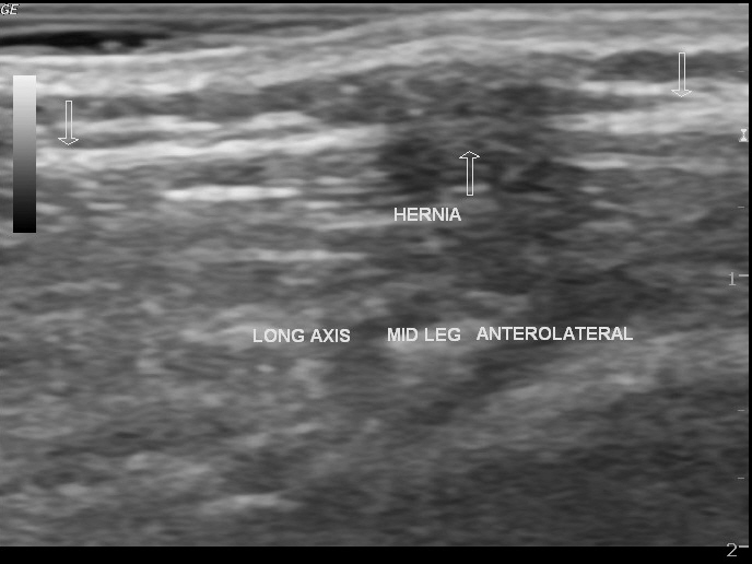 Tibialis anterior muscle hernia | Image | Radiopaedia.org