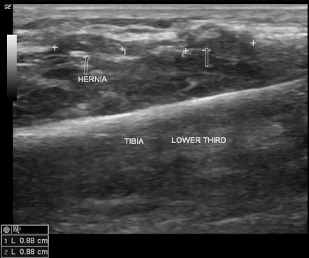 Tibialis anterior muscle hernia | Image | Radiopaedia.org