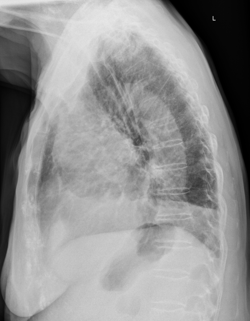 Malignant thymoma (thymic carcinoma) | Image | Radiopaedia.org