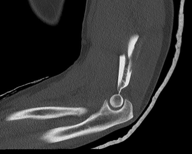 Humeral fracture with butterfly fragment | Image | Radiopaedia.org