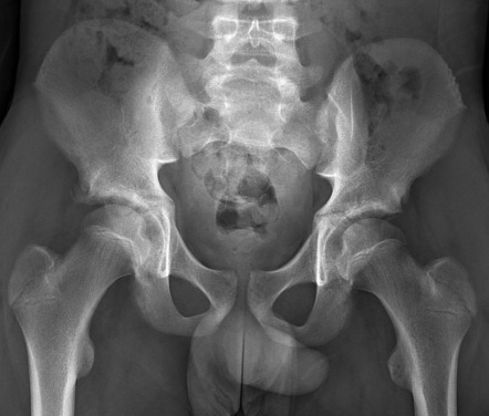 Anterior inferior iliac spine avulsion fracture | Radiology Case ...