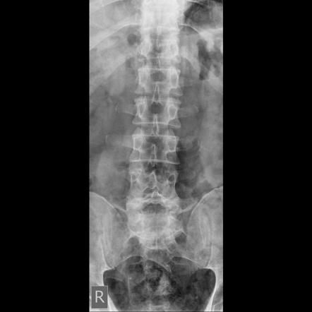 Spondylolisthesis (grade II) | Image | Radiopaedia.org